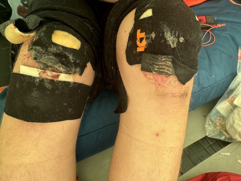 This is what the condition called polar thigh looks like, but on the knee