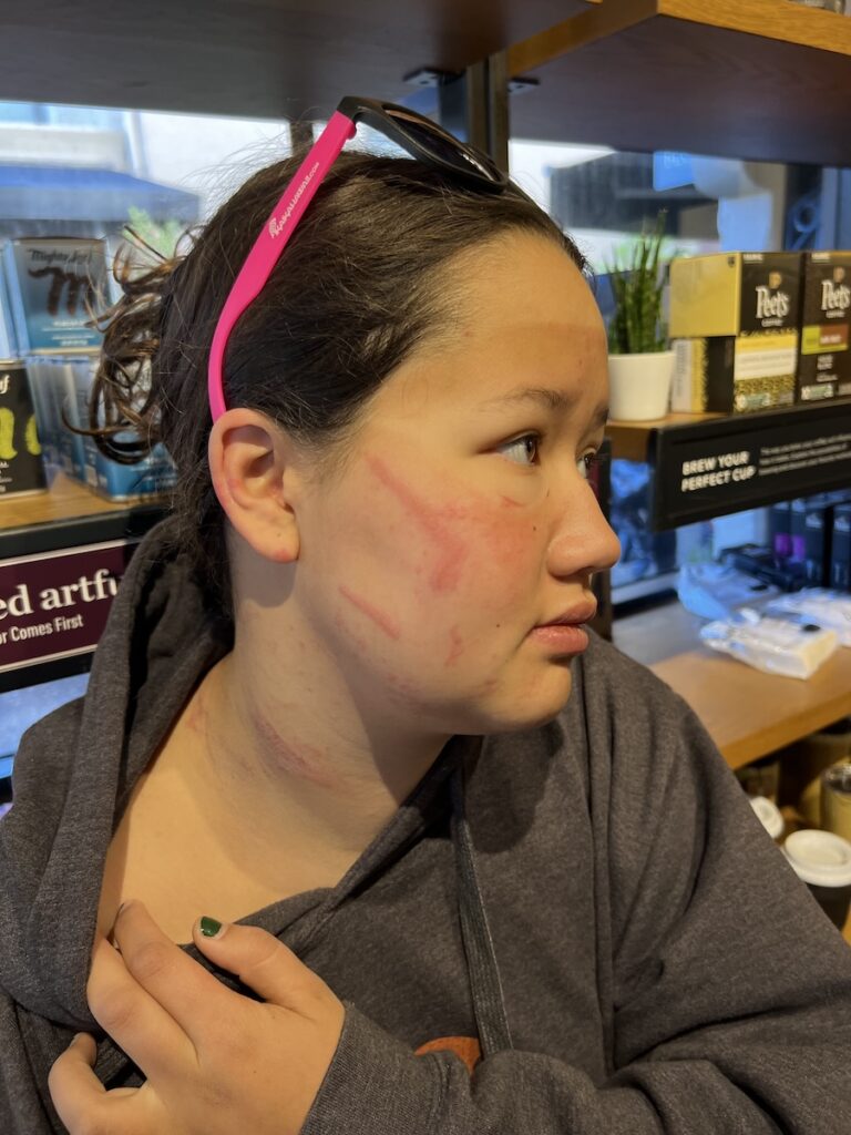 Maya with jellyfish stings across her face and neck