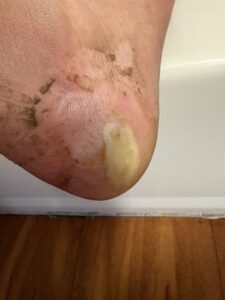 Blister on my heal