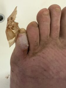 Blister on my little toe